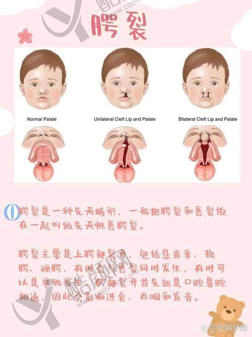 重庆松山医院夏德林做唇腭裂二期修复46800元，精细技艺重塑自信笑容 