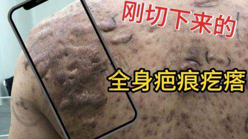 五、成都医 大医院疤痕科怎么预约：