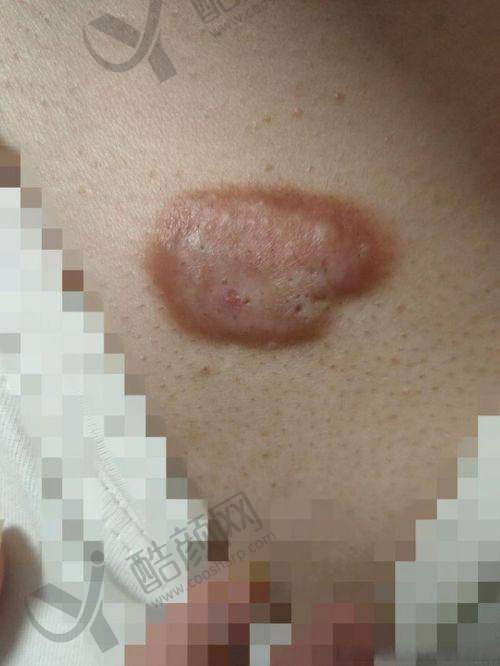 七、成都医 大医院疤痕科真实的患者评价如下：