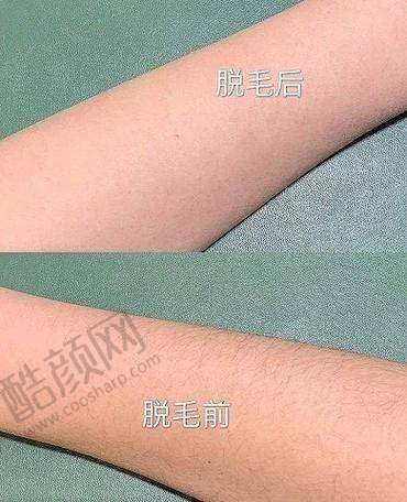 西安艺星李婧医生做全身脱毛价格2000元起，国际化医美理念与技术，服务贴心有保障 