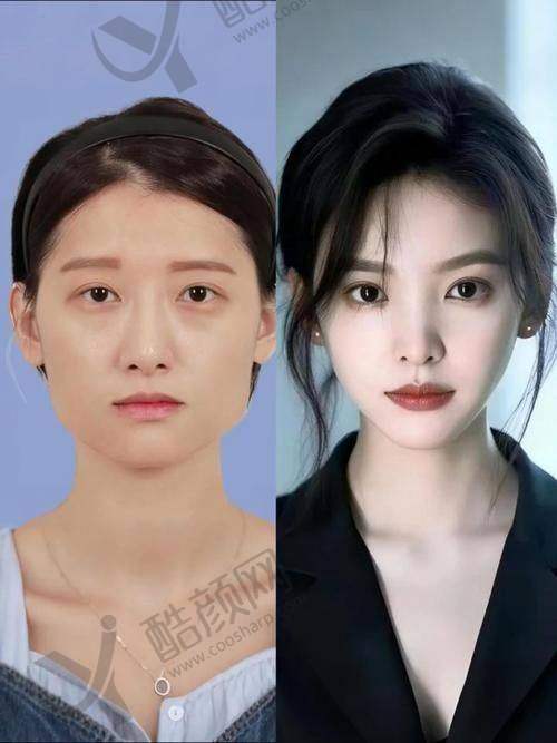 磨骨医生张立天磨骨手术怎么样？