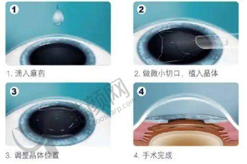 徐州华厦眼科医院杨建华院长ICL晶体植入手术31000元起，高端设备护航视力矫正 