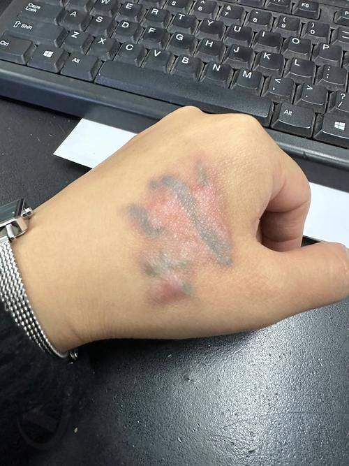 邯郸莱媚俪手臂去纹身项目优势