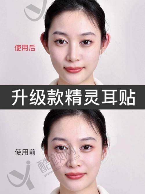 武汉正璞招风耳修复真实评价
