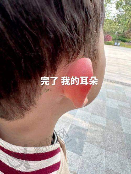 武汉正璞招风耳修复项目优势