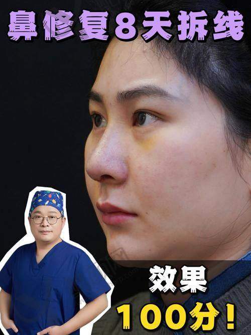 广州可玉罗勇做鼻修复价格35000元起，显微技术减挛缩，术后痕迹超淡！ 