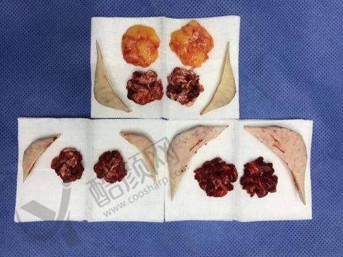 王涛：双鄂与轮廓磨骨高能医生