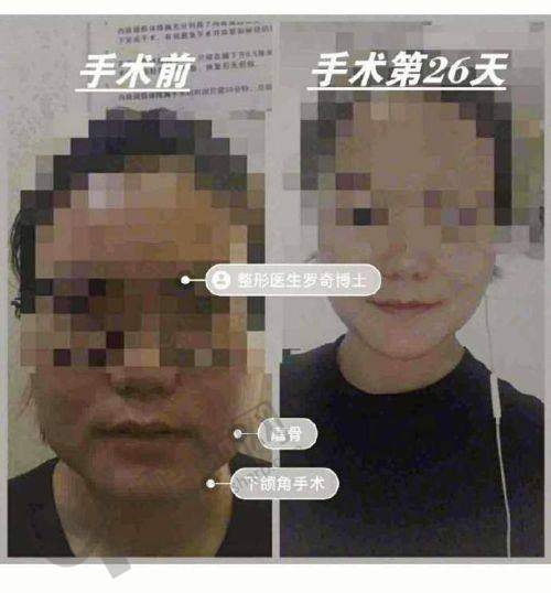 李志海——专注颌面多年的磨骨骨干医生