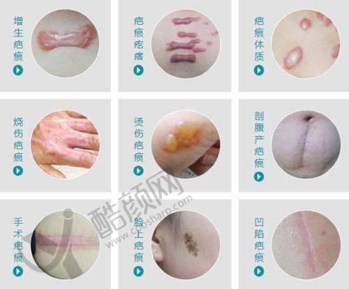 攀枝花俪妍馆医学美容医院:疤痕细胞种植术修复深度创伤疤