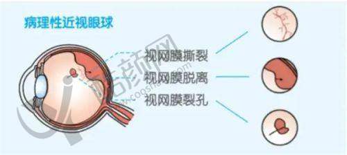 国内做后巩膜加固术的医生排名如何？王乐今等5位医生技术优经验丰效果好