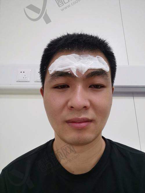 深圳富华整形注射去抬头纹真实评价