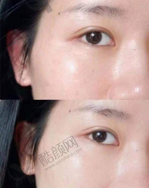 深圳美莱杨鹏医生做黄金超光子价格888元起，能改善色斑、红血丝等