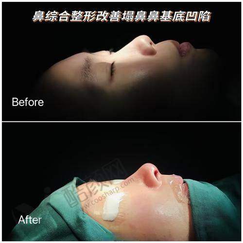 广州韩妃刘志刚医生做隆鼻怎么样？