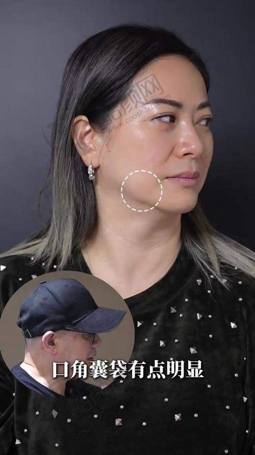 邯郸莱媚俪激光拉皮真实评价