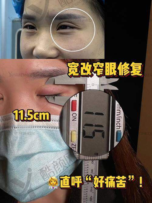北京丰联丽格双眼皮修复的具体优势