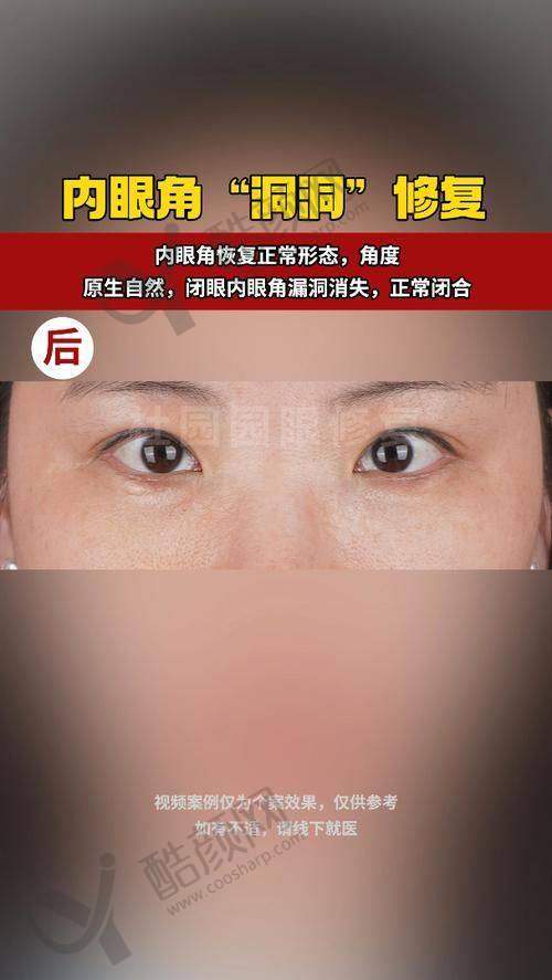 北京丰联丽格师丽丽双眼皮修复价格2.8万起，AI预演+终身维保打造自然美眼！ 