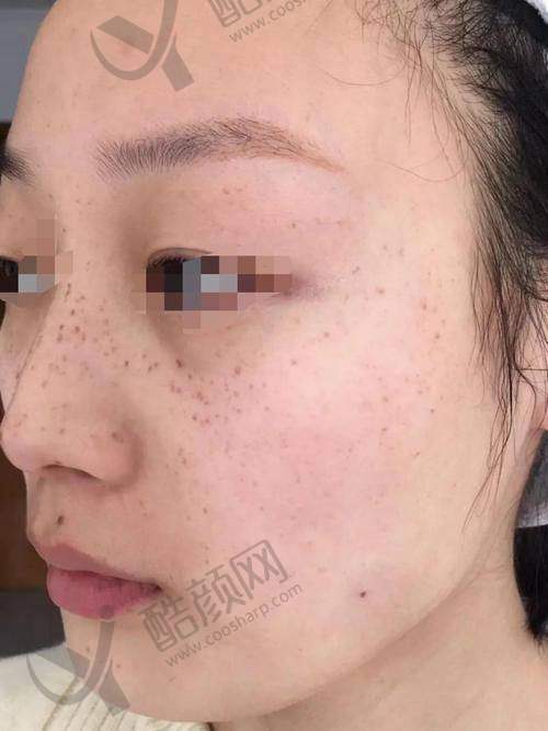 北京丰联丽格医疗美容光子嫩肤真实评价