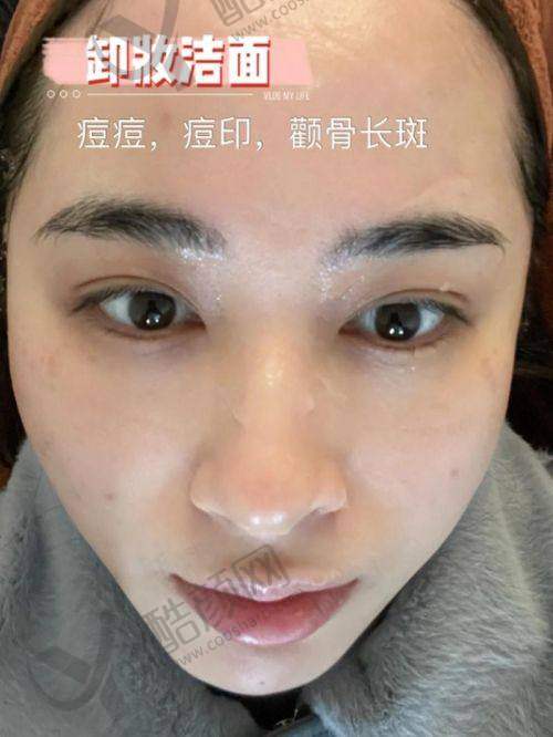 北京丰联丽格医疗美容师丽丽医生光子嫩肤800元起，官网认证正规靠谱体验优 