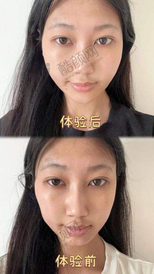 上海华美聂婕医生注射玻尿酸怎么样？