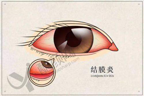 五、晋城爱尔眼科医院怎么预约：