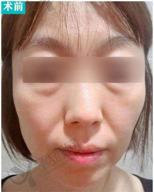 郑州悦容整形医院李戈医生做拉皮手术价格9800元起，深筋膜复位+VIP病房超贴心 