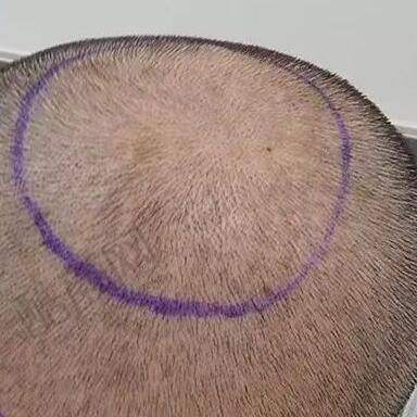 六、广州碧莲盛植发价格表:(仅供参考)