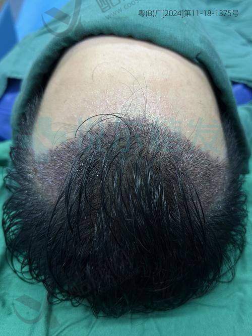 一、广州碧莲盛植发怎么样?