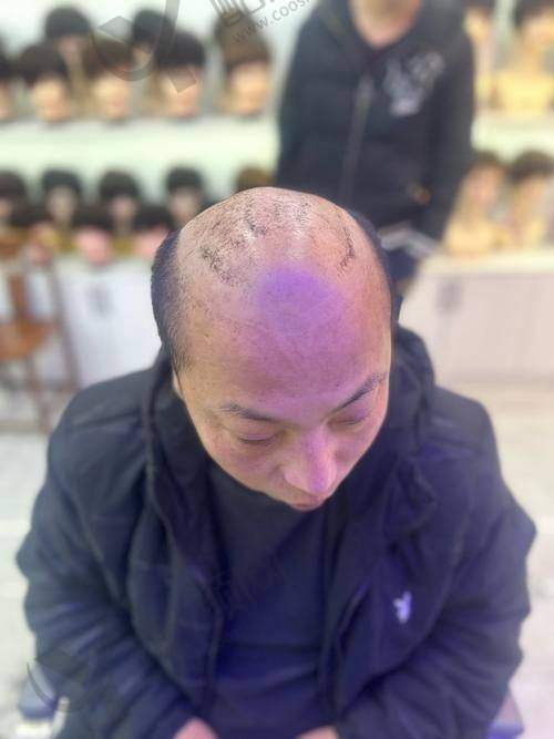 七、广州碧莲盛植发真实的患者评价如下: