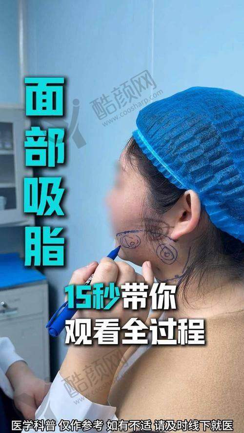 成都初龄医院5G天使光雕面部吸脂的具体优势