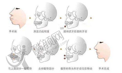 五、深圳大学总医院整形科怎么预约: