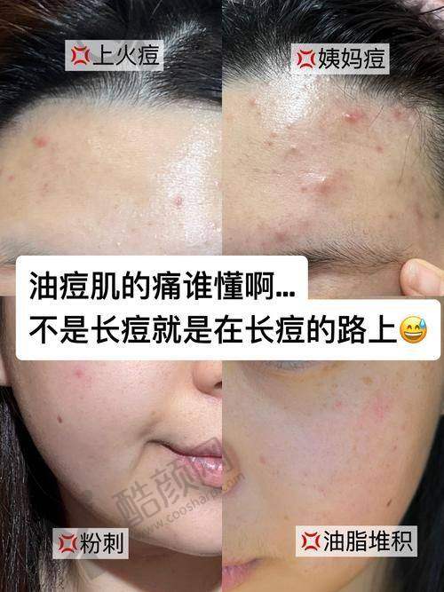 昆明昆大疤痕医院痘坑痘印治疗真实评价