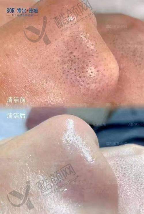 昆明昆大疤痕医院痘坑痘印治疗项目优势