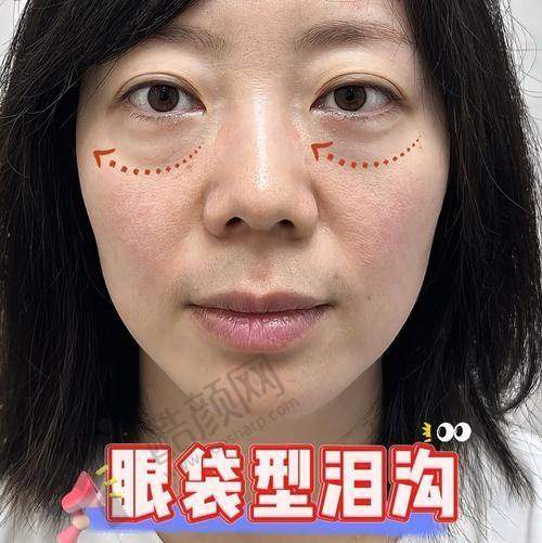 六、杭州健丽（去眼袋）医疗美容诊所价格表：（仅供参考）