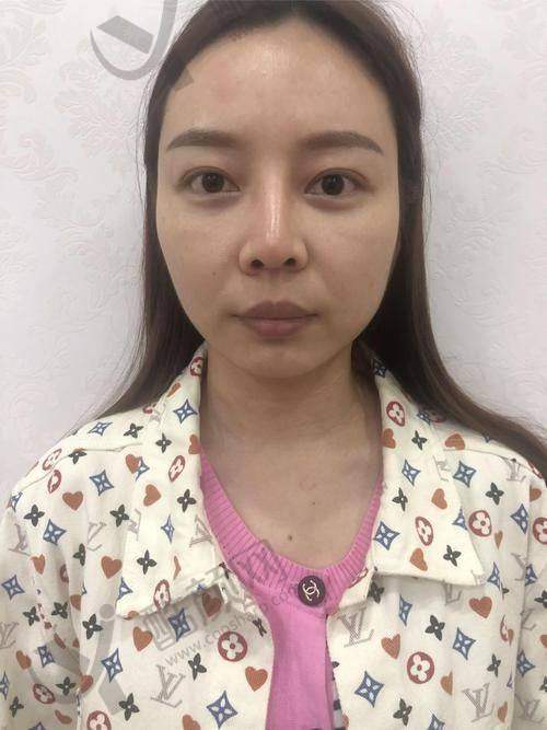 深圳宝丽医疗美容门诊部李信锋医生鼻修复手术怎么样？
