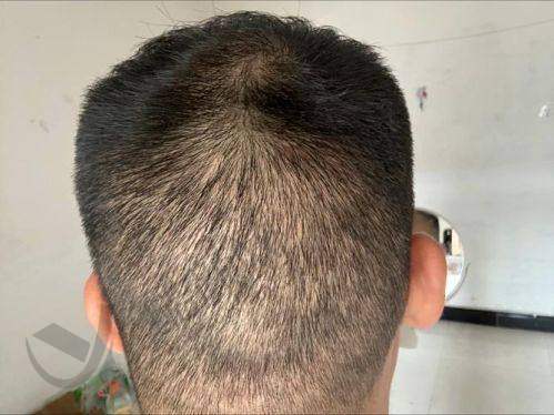 五、南京新生植发开展的项目：