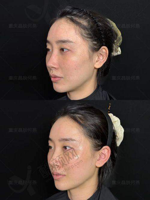 李晓东医生面部提升怎么样？