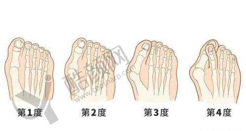 李广学医生去川字纹真皮填充技术特点:自然长效抗衰,规避栓塞风险
