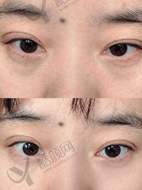 七、北京轻美颜（眼袋提升）医疗美容诊所真实的患者评价如下：