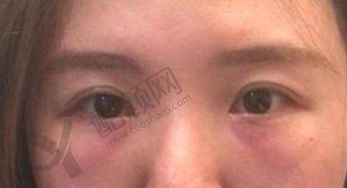 六、北京轻美颜（眼袋提升）医疗美容诊所价格表：（仅供参考）