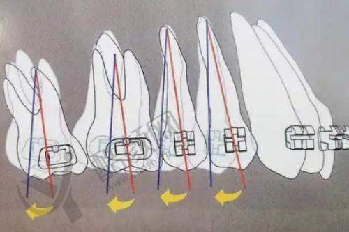 刘可乐正畸医生隐形矫正水平怎么样可靠吗？