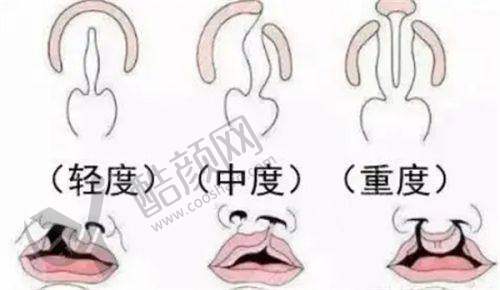 余文林唇裂修复成功实例