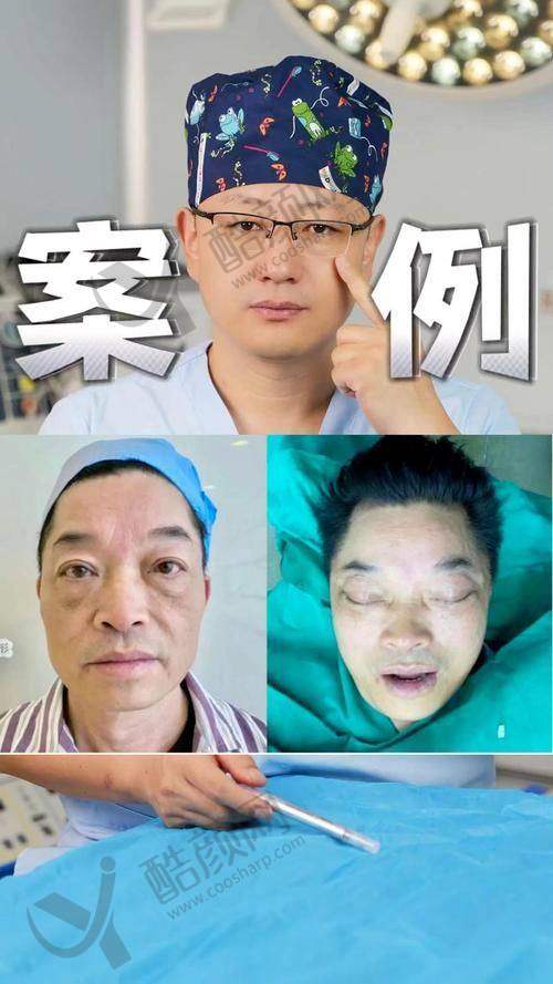 袁强博士拉皮手术价格
