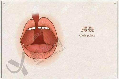 余文林唇裂修复价格