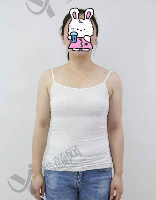 福州名韩整形——温名赟医生，棉花糖复合隆胸出名