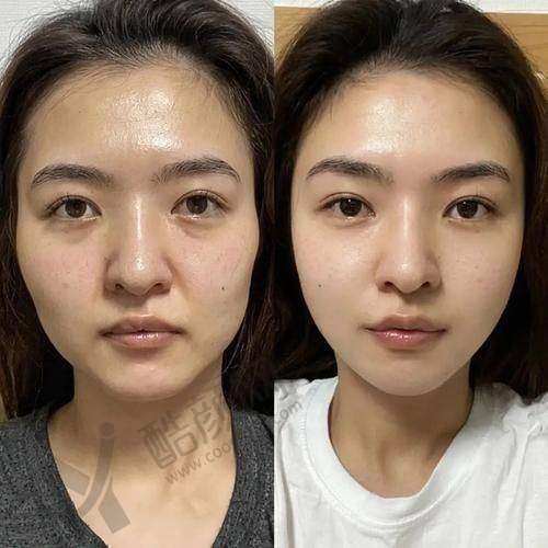 成都李健钢无痕筋膜提升价格情况