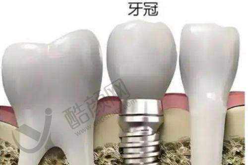 韩超种植牙实例