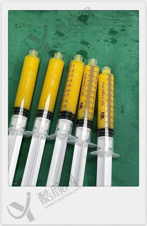 成都西区医院宋华敬抽脂成功实例：成效显著看得见