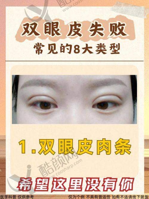 郑小红双眼皮修复成功实例