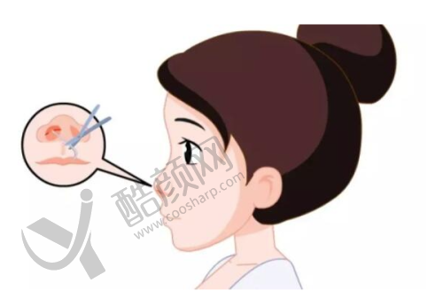 菲林普利隆鼻价格大揭秘：综合优势让你美丽无忧