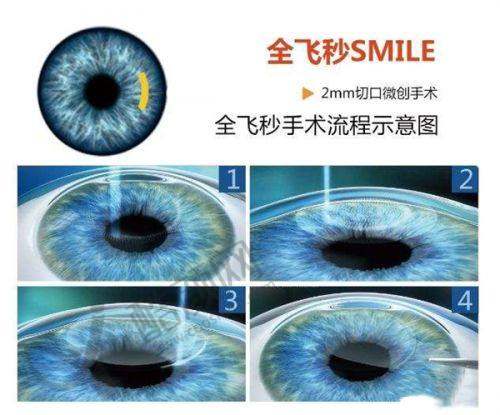乐山爱尔眼科近视手术价格：半飞秒15800+，全飞秒21800+，技术靠谱口碑佳别错过